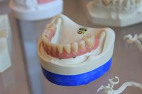 Голямо разнообразие зъбни импланти цени 13