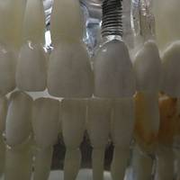 Нашият каталог с  зъбни импланти цени 2
