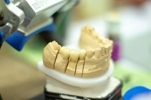Spectacular Dental Implants Bulgaria 30