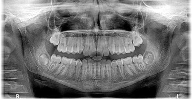 Видове избелване на зъби 24