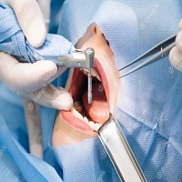 видове зъбни импланти - 42405 варианти