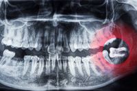 зъбни импланти - 2466 типа
